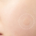 Skin Tag Removal Kit | Small & Standard Skin Tag Remover Device | Painless Skin Tag Remover