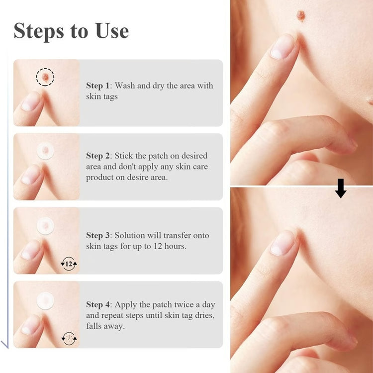 Skin Tag Removal Kit | Small & Standard Skin Tag Remover Device | Painless Skin Tag Remover