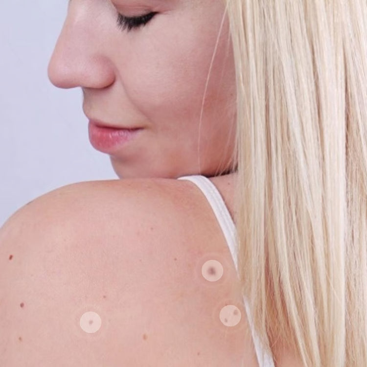 Skin Tag Removal Kit | Small & Standard Skin Tag Remover Device | Painless Skin Tag Remover